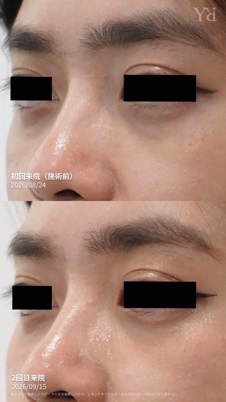 SUNEKOS under-eye care: first treatment to second visit