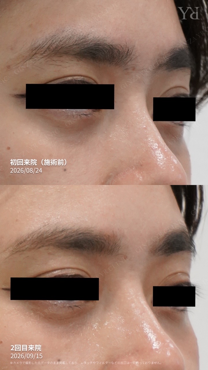 SUNEKOS under-eye care: first treatment to second visit