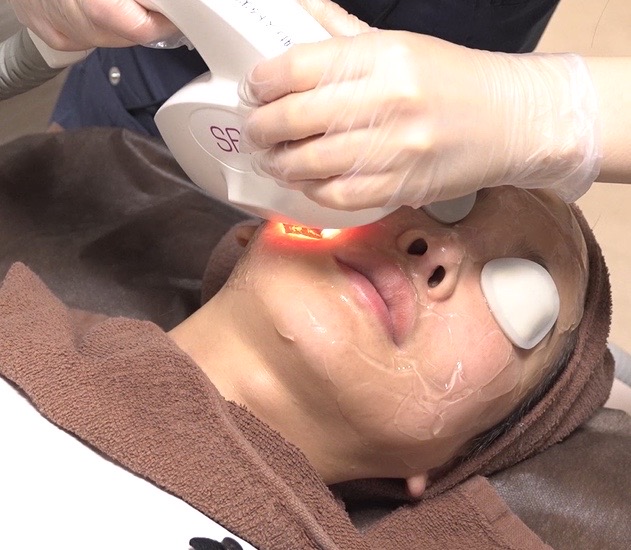 IPL photofacial | pigmentation, redness and uneven tone