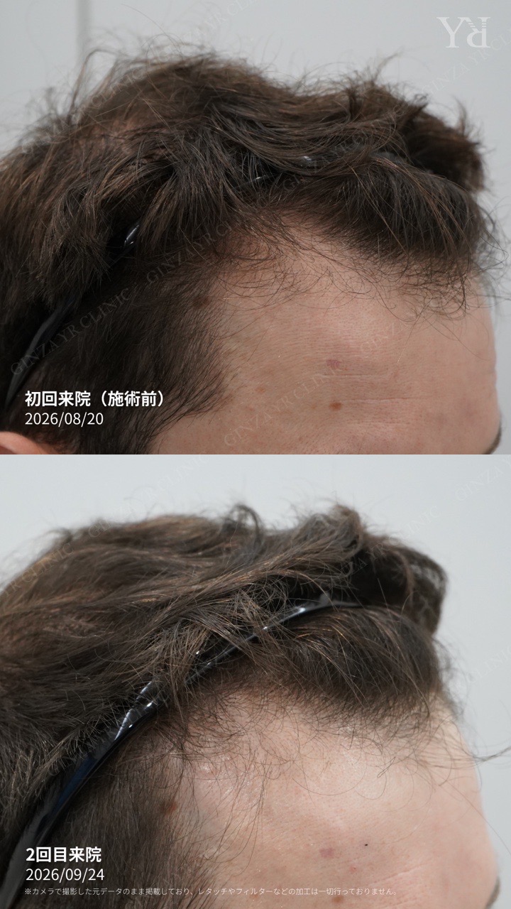 Male scalp care: one-month follow-up record