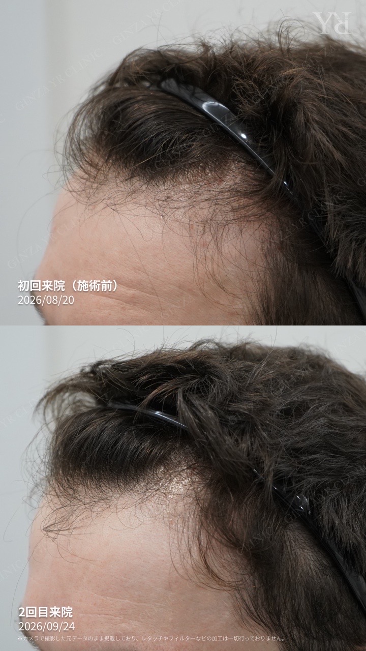 Male scalp care: one-month follow-up record