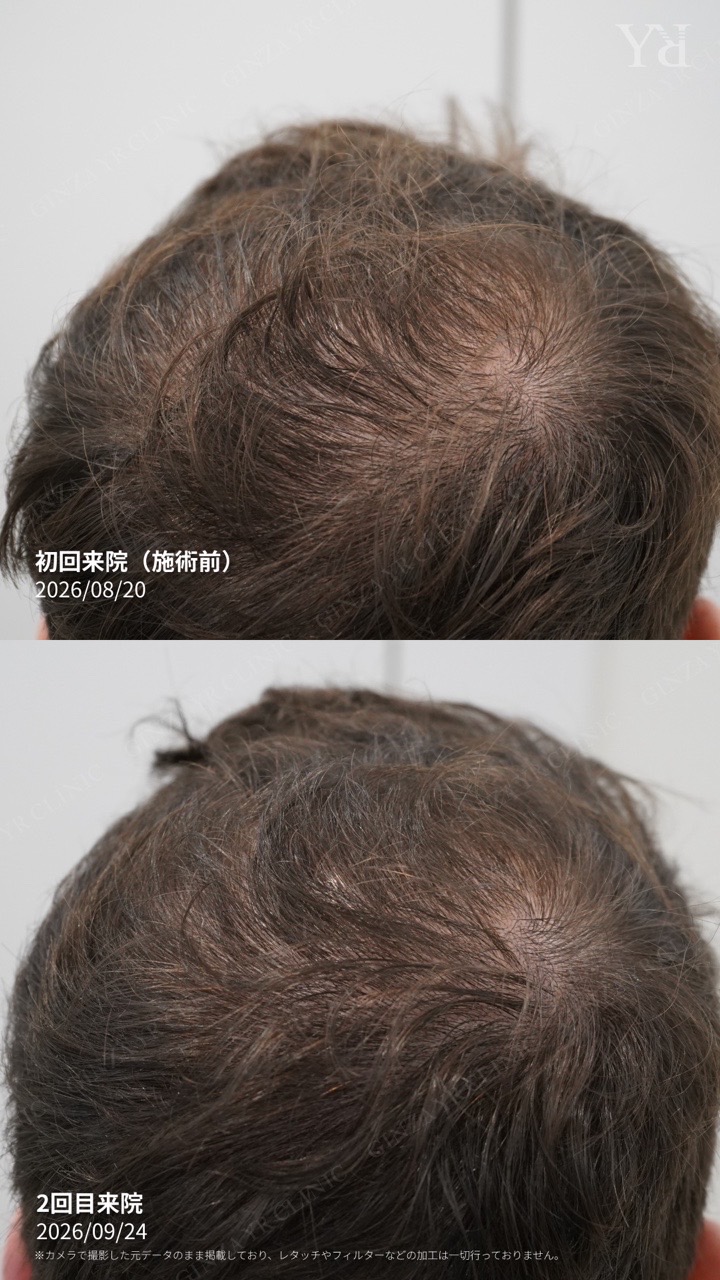 Male scalp care: one-month follow-up record